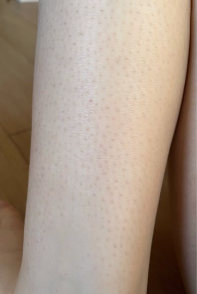 目立つので今は毛剃ってないので汚くてすみません 赤い 脚の毛穴の目立ち Yahoo 知恵袋