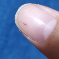 爪の黒い線についてです 3日前に右手親指の爪に細くくっきりした線がある事に Yahoo 知恵袋