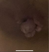 高校2年生です 小学5年からイボ痔を患っています 最近では便のとき Yahoo 知恵袋