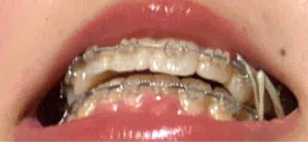 これって歯列矯正失敗ですか 上の歯と下の歯の前歯どうしの隙間がかなり Yahoo 知恵袋