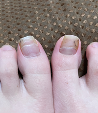 足の爪についてこの足の爪はなにかの病気ですか 4月頃に1ヶ月間 Yahoo 知恵袋