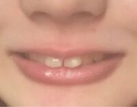 矯正後の後戻りについて 2年の矯正後 マウスピースのリテ Yahoo 知恵袋