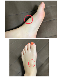 足の甲に骨の出っ張りがあります 左足のみで親指と足首のちょうど真 Yahoo 知恵袋