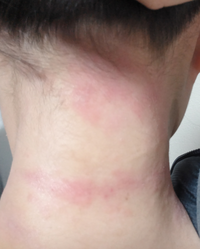 首が写真の通り荒れていてあまり他人に見られたくありません でも部活があるの Yahoo 知恵袋