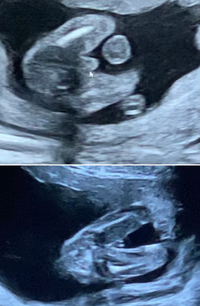 18週エコーです 男の子女の子どちらに見えますか 動画をスク Yahoo 知恵袋