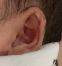 赤ちゃんの耳の形整形したことがある方教えてください費用 時間はどのくらいか Yahoo 知恵袋