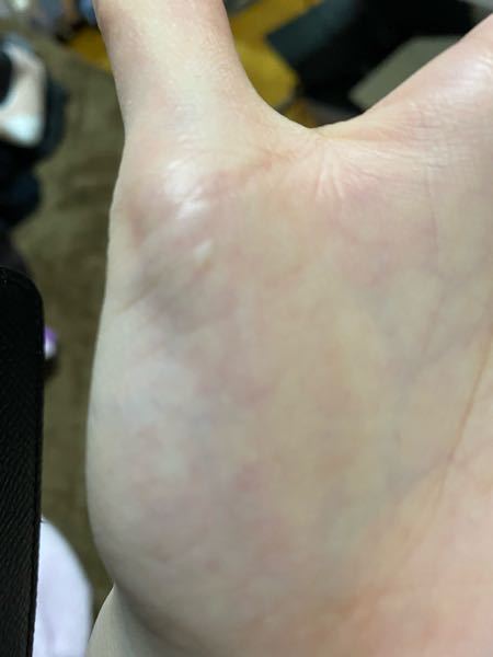 この掌にある水疱？は水虫の一種でしょうか？ 普段は痒みはないのですが、たまに無性に痒くなる時があります…。それと足の裏に水虫を持っています。そして画像の様な水疱が少しあります。(治療しているので...