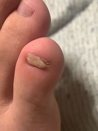 足の小指の爪が割れて剥がれかかっています これは固定して再生を待つの Yahoo 知恵袋