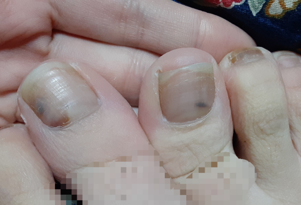 爪の色が2ヶ月くらい変なのですが これは重い病気のサインでしょうか?