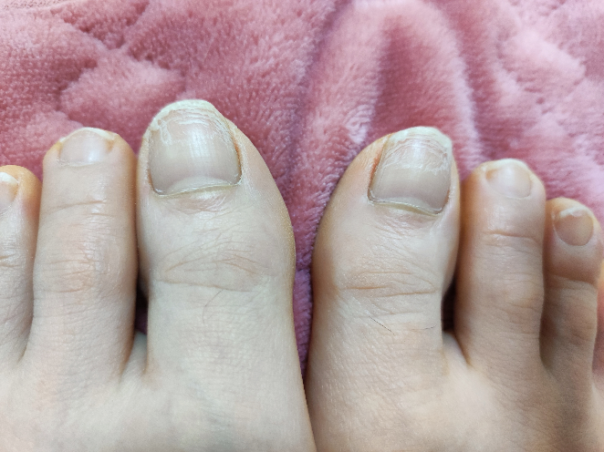 親指の爪がこのように、上の方だけ白い傷のような線が入っていて、爪を切っても同じ様な状態が続いきます。 水虫の可能性あると思いますか？ かゆみなど症状はなく、親指だけです。