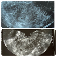 6w0dですが胎嚢が小さめで空っぽです 卵黄嚢も胎芽も見えません 枯死卵な Yahoo 知恵袋