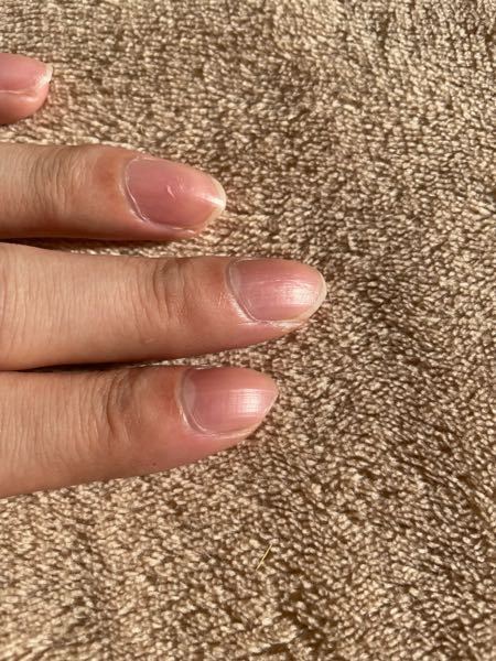 10代男です 爪の縦線が酷く 綺麗にしたいです 主なケア方法や商品あ Yahoo 知恵袋