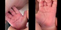 生後1ヶ月の息子の手相なんですがこれはますかけ線という手相でしょうか？写真は左から右手、左手の順です。 