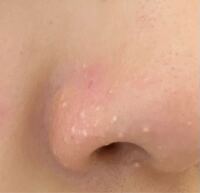 鼻まわりのぶつぶつについてです 鼻まわりに白いぶつぶつ にきび のようなもの Yahoo 知恵袋