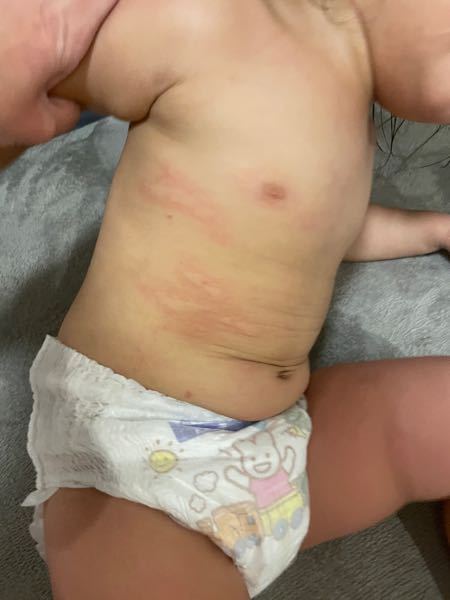 2歳の娘の体に急に蕁麻疹？のようなものが現れました。 アレルギーは調べては無いですが今まで出たことはなく ここ数日変わったものを食べたとかはありません。 虫刺されでしょうか？足から顔まで全身に出...