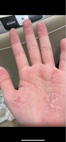 最近手のひらの皮が画像のように剥けています。乾燥でしょうか？ 皮が剥ける前は手湿疹がありました。今も若干残っていますが痒みは無くなりました。
