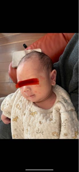 新生児の脂漏性湿疹について教えて下さい 生後3週間くらいか Yahoo 知恵袋