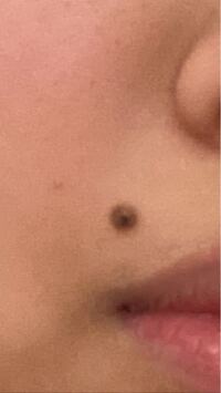 大至急です このほくろを自分で取ります 針や爪切りを使って Yahoo 知恵袋