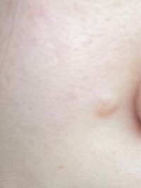 ほくろ除去についての質問です 同じ皮膚科で過去に同じ箇所2回ほくろ除去 Yahoo 知恵袋