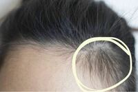 ここのおでこの生え際の産毛が伸びてすごく癖がついてしまって、ここの部分だけ孤立しちゃって右と左で前髪の量が変わってしまいます、、 どうすれば治りますか？剃るのはダメですか？
画像はネットのものです！