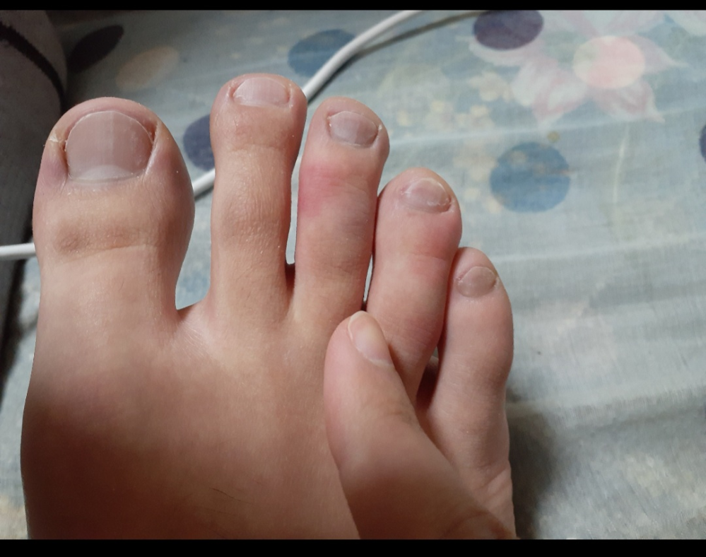 足の中指と薬指が赤くなって痒いです。 これって水虫ですか？