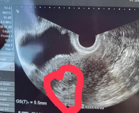 5週2日目昨日内診して胎嚢確認出来ましたが先程トイレに行ったら水 Yahoo 知恵袋