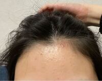 おでこのニキビがずっと治りません泣 今使っているスキンケア用 Yahoo 知恵袋