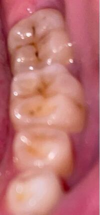 歯の写真有り虫歯 最近うつ病で歯磨きをサボりがちだったのです Yahoo 知恵袋