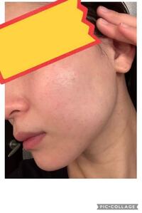 妊娠27週 妊娠7ヶ月 です 急に肌荒れがすごくなってきました なった方い Yahoo 知恵袋