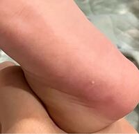 息子 赤ちゃん5ヶ月 の足の裏に白いプツプツができています 皮 Yahoo 知恵袋