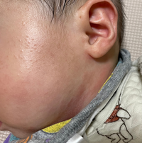 赤ちゃんの湿疹とまぶたの赤みについてです 先ほど生後二ヶ月の子供の顔を見たら Yahoo 知恵袋