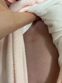 赤ちゃんの湿疹 剣状突起らについて 生後28日目の赤ちゃん Yahoo 知恵袋