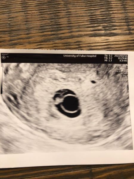 稽留流産ほぼ確定1週半くらい心拍が確認されず 成長もほぼしていない 赤ちゃ Yahoo 知恵袋