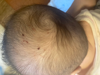 生後3ヶ月の赤ちゃんです 今朝起きたら頭皮に血の塊がありました ベビーベッ Yahoo 知恵袋