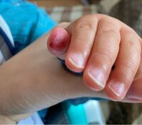 一歳の子どもなのですが 毎日指しゃぶりしてる為内出血していま Yahoo 知恵袋