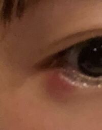 ものもらいがもう1ヶ月はなおりません 眼科は2回行き目薬塗り薬を続けていま Yahoo 知恵袋