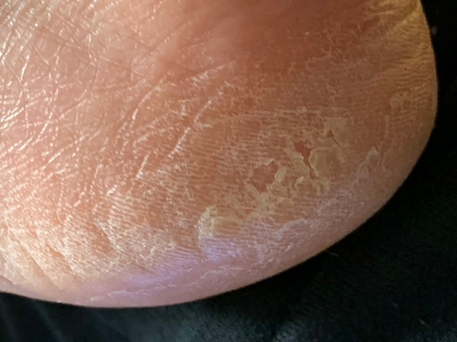 これは水虫ですか？ 画像は踵です。 カサつきのみで痒みや痛みはありません。 指の間などに同様の症状は出ていませんが、指のはらと、母趾内転筋横頭には同様のカサつきが見られます。