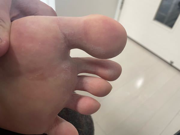 この写真は水虫ですか？？ 指と指の間にはこのような症状はありませんが、 全指が、皮が剥けている状態です。 痒みはありませんが、先週あたりに急に両足にできました。 よろしくお願いします！