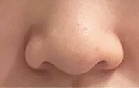 鼻整形 このような鼻を綺麗な鼻にするのにはどんな施術が必要ですか？ 横幅は約3.5cm 高さも横を向いた時Eラインができる程度ですが普通ぐらいの高さだと思います。 理想はredvelvetのアイリーンさんのようなストレートノーズか、twiceのモモさんのような忘れ鼻です。