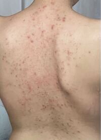 閲覧注意 背中ニキビ 跡の画像があります 背中ニキ Yahoo 知恵袋