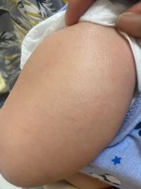 もうすぐ生後2ヶ月です 手足がザラザラしています 見にくい Yahoo 知恵袋