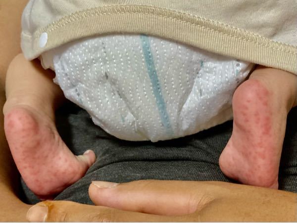 子どもの病気とトラブル 解決済みの質問 Yahoo 知恵袋