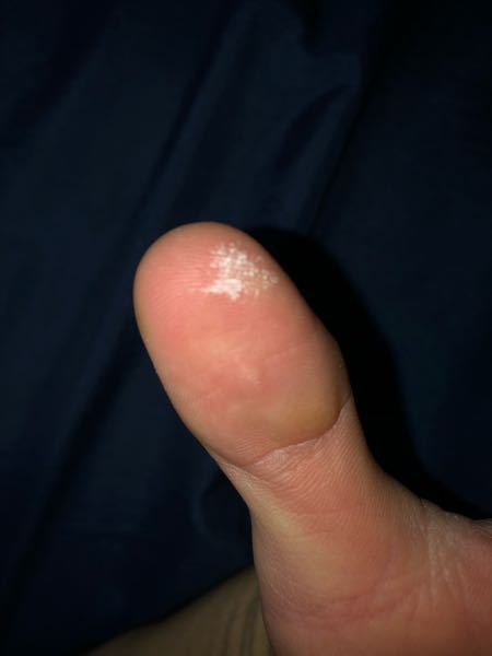 スマホをいじってたら指先がチクッとして、指先を見て見たら皮膚が白くなっていました(皮が剥けてる？)。1分前には無かったです。痛みとしては火傷に近い感じです。なんだと思われますか？