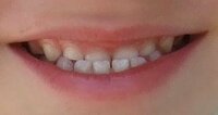 子どもの受け口 子どもが写真のように受け口です。
来月４歳なので、歯は全部乳歯ですが、もし永久歯になった時に受け口が自然に治らなかった場合、何歳ぐらいでどういう治療をするのですか？

主人も小さい頃は受け口だったらしく、今は矯正で上の歯と下の歯がぶつかる形まで直したようですが、今の時代でも矯正してもそのようになり、上の歯が下の歯にかぶるようになるまでは治らないのでしょうか？

ちな...