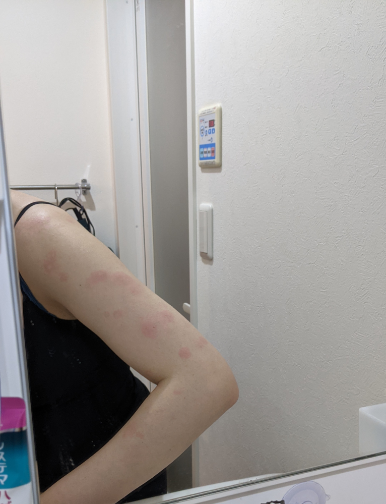 これは蕁麻疹でしょうか。 何かの虫でしょうか。 足と腕に出ていて、ほんの少しの痒みがあります。