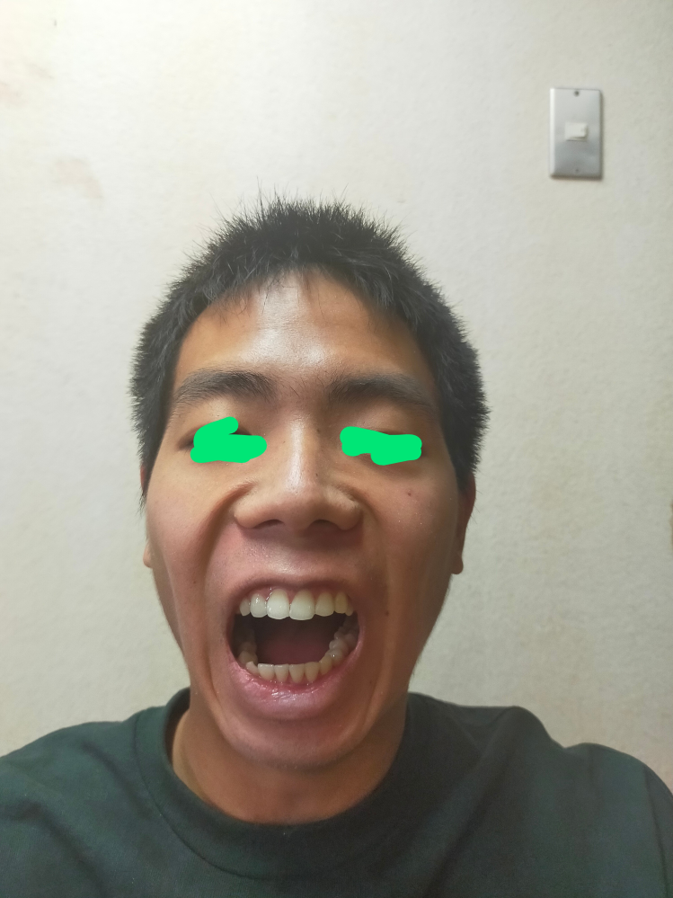 非復位性関節円板の顎関節症です 9年前に歯科矯正が終わって顎が鳴り出し そ Yahoo 知恵袋