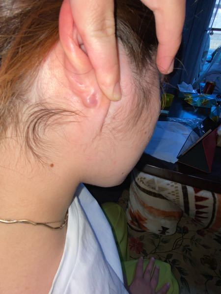 ここ最近、耳の裏にぷつっと膿のようなものができています。なんでしょうか？