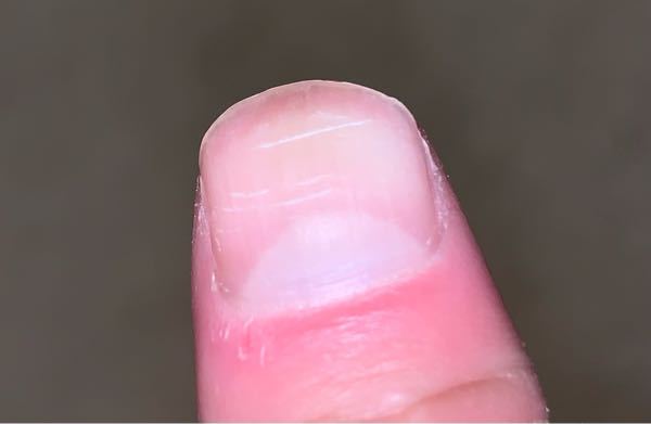 男です このような傷ついた爪を治して綺麗にする方法を教えてください またこ Yahoo 知恵袋