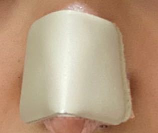 鼻尖形成 (耳軟骨移植) をしたのですが、このギプスは3日間だけでいいのですか？ 説明してもらった紙には5月27日まで鼻の固定とあるのですが、このギプスも含めて27日までつけてるのかわからず、、 回答よろしくお願いします。