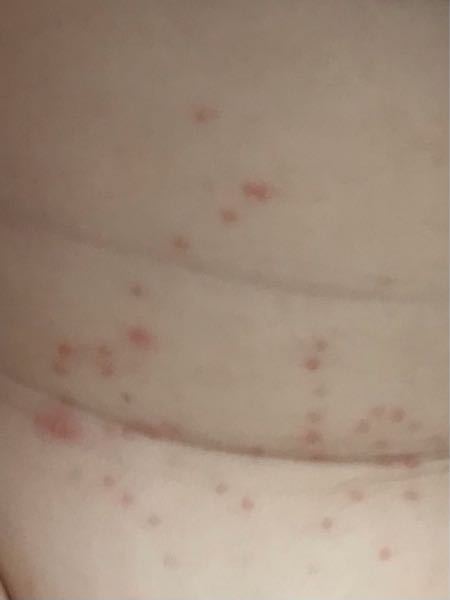 生後6ヶ月の娘の湿疹について 急にこの様な赤いプツプツができていました。 かゆがったり痛がったりする様子はありません。 へその下から、おまたにかけてと 足の付け根のシワにも少しできています。 3日程経ちましたが良くも悪くもなってないです。 画像が荒くてわかりずらいかもしれませんが 何かわかる方いらっしゃったら教えて頂きたいです！ よろしくお願い致します。